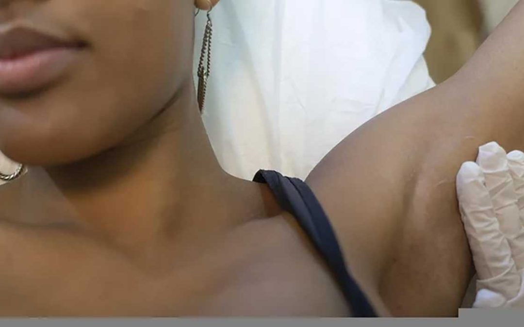 Ventajas de la depilación láser