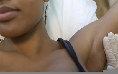 Ventajas de la depilación láser