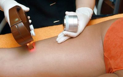 4 Beneficios de la depilación láser diodo